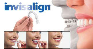 Invisalign Dentist in North York near Dublin Heights