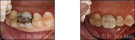 dental fillings - cavities - wilson heights and sheppard Toronto