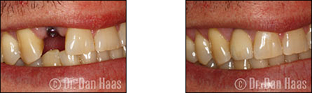 dental implants - bathurst manor