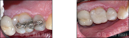 dental onlays - silver fillings - Sheppard West TTC subway station (formerly Downsview) toronto