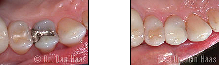 dental onlays - porcelain inlays - bathurst manor toronto