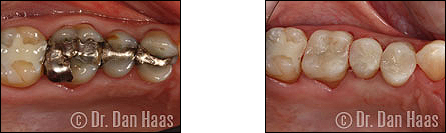 dental onlays - tooth cavity - dublin heights