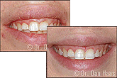 Cosmetic and Restorative Dentistry in North York - Before and After Pictures