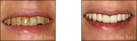 Veneers Case 1