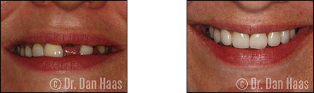 Veneers Case 3